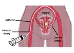 Uterine Fibroid Treatment In Delhi